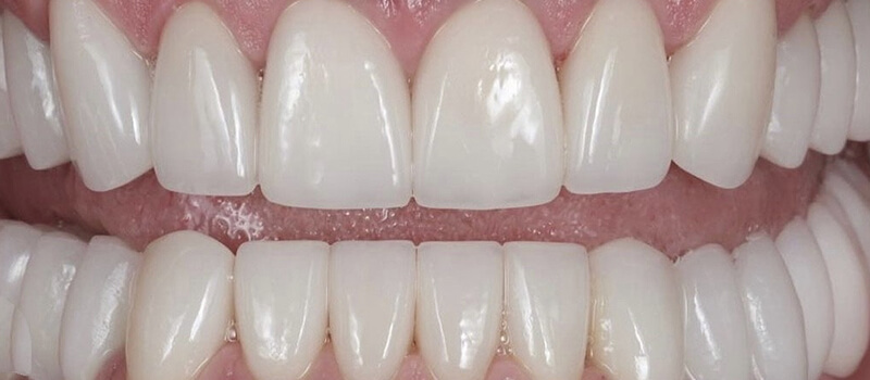 After - Veneers Case 4 at Valley Dental & Orthodontics