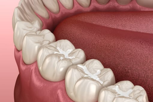 Dental Sealants