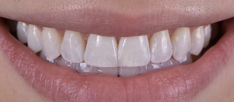 After - Invisalign Case 1 at Valley Dental & Orthodontics