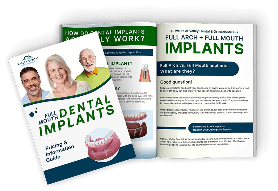 Dental Implant Guide