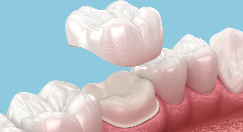 Same-Day Crowns Clovis CA Explained: Quick, Comfortable, and Expert Care Near You