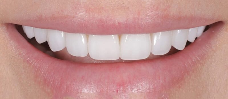 After - Veneers Case 1 at Valley Dental & Orthodontics