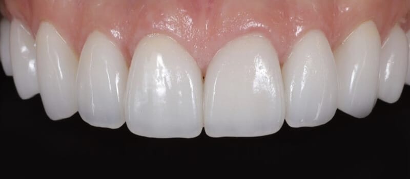 After - Veneers Case 2 at Valley Dental & Orthodontics