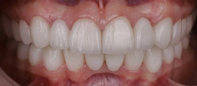 After - Veneers Case 3 at Valley Dental & Orthodontics