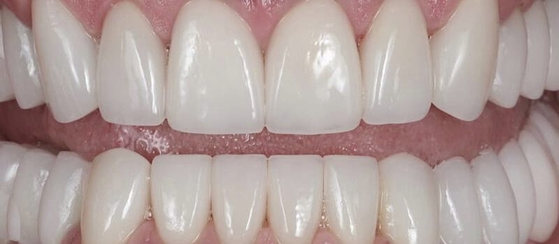 After - Veneers Case 4 at Valley Dental & Orthodontics