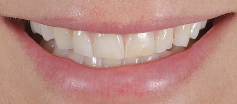 Before - Veneers Case 1 at Valley Dental & Orthodontics