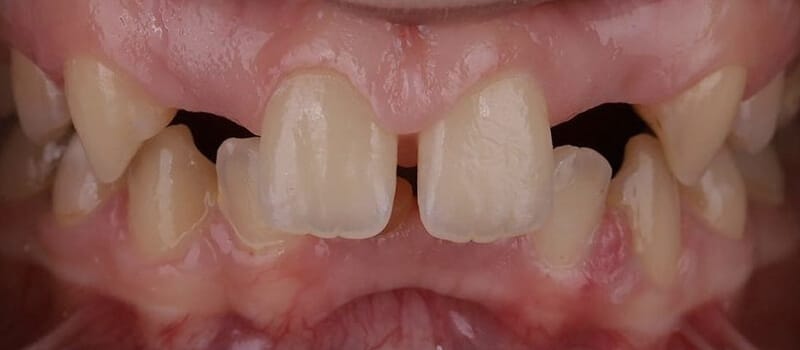 Before - Veneers Case 3 at Valley Dental & Orthodontics