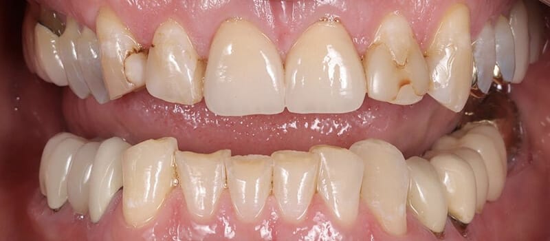 Before - Veneers Case 4 at Valley Dental & Orthodontics