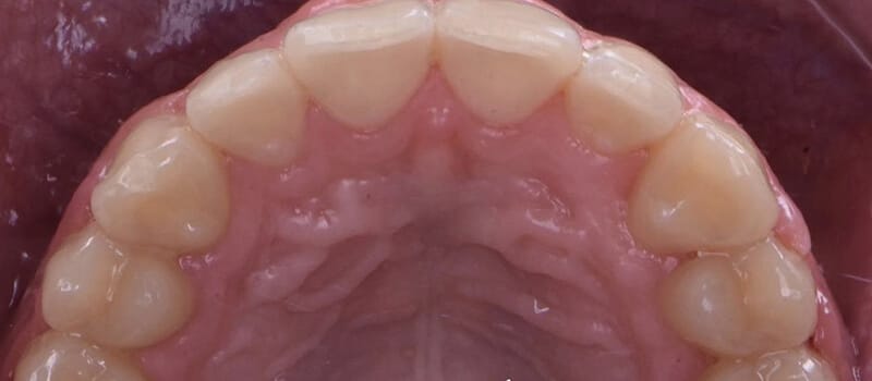 After - Braces Case 1 at Valley Dental & Orthodontics