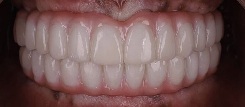 After - All-on-4 Case 1 at Valley Dental & Orthodontics