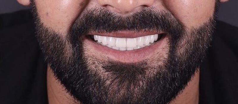 After - All-on-4 Case 2 at Valley Dental & Orthodontics