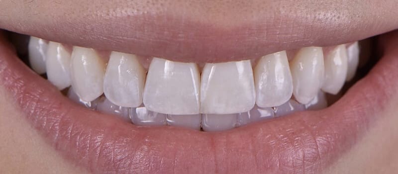 After - Invisalign Case 1 at Valley Dental & Orthodontics
