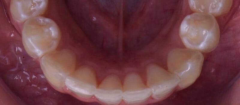 After - Invisalign Case 2 at Valley Dental & Orthodontics