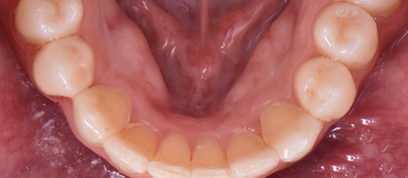 After - Invisalign Case 3 at Valley Dental & Orthodontics