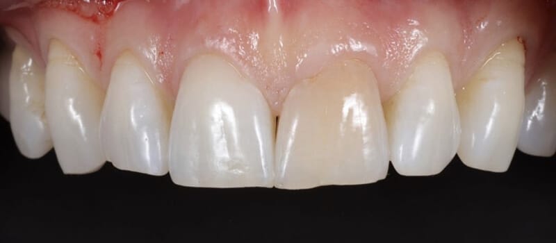 Before - Veneers Case 2 at Valley Dental & Orthodontics