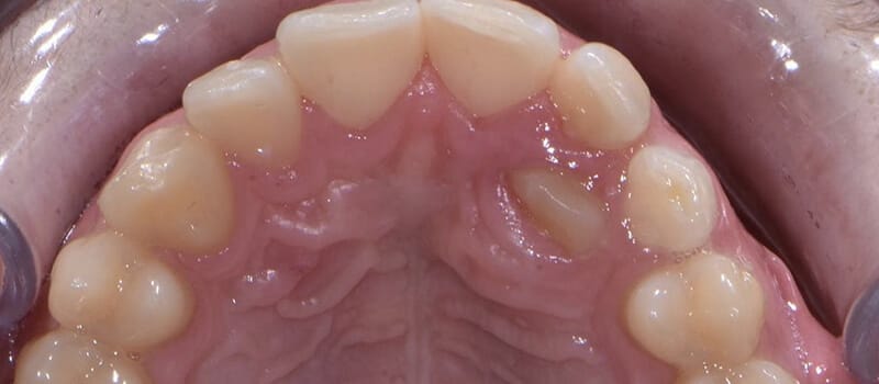 Before - Braces Case 1 at Valley Dental & Orthodontics