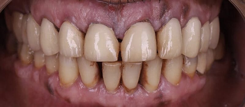 Before - All-on-4 Case 1 at Valley Dental & Orthodontics