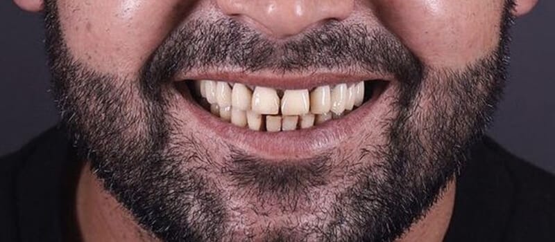 Before - All-on-4 Case 2 at Valley Dental & Orthodontics