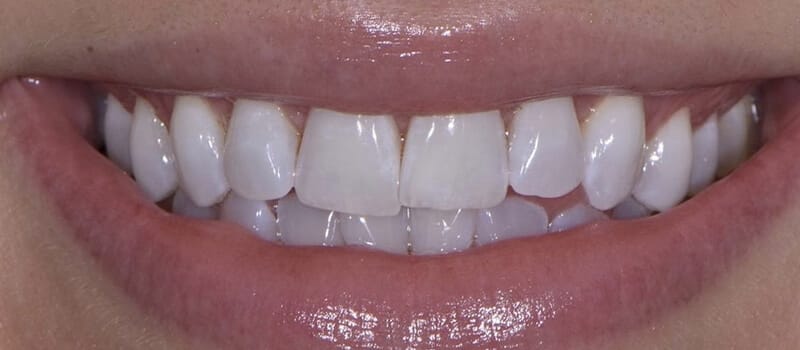 Before - Invisalign Case 1 at Valley Dental & Orthodontics