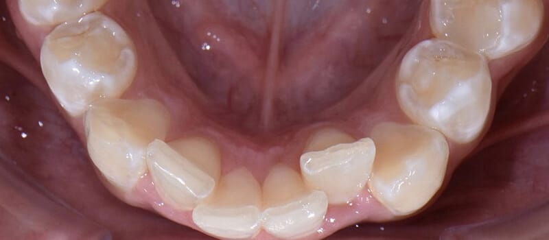 Before - Invisalign Case 2 at Valley Dental & Orthodontics