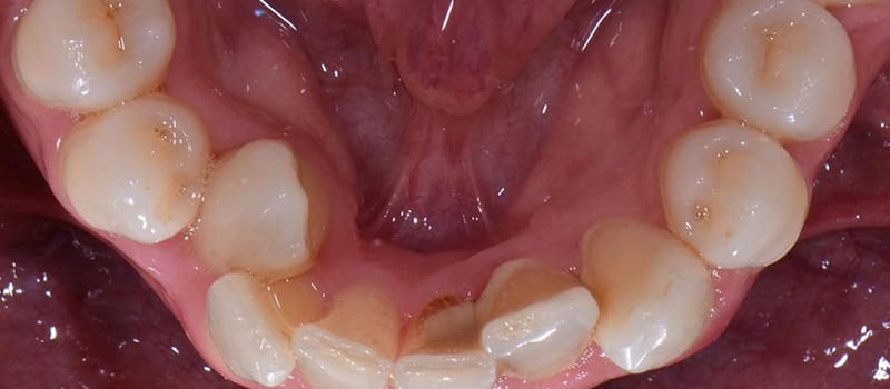 Before - Invisalign Case 3 at Valley Dental & Orthodontics