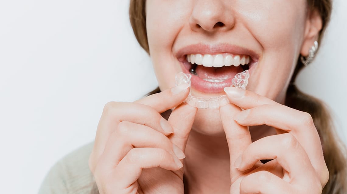 Clear Aligners: Straighten Your Teeth Discreetly